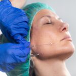 PLLA Threads: A Long-Lasting Solution for Thread Lifts