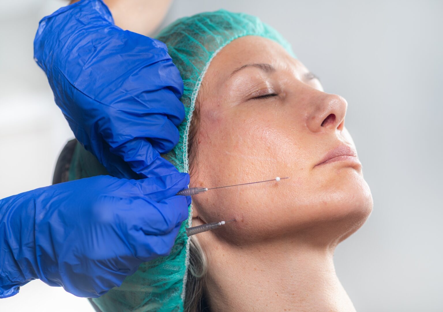 PLLA Threads: A Long-Lasting Solution for Thread Lifts - zevanex.ae
